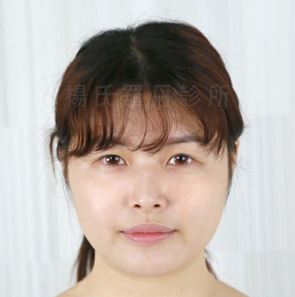 瘦臉 詹永璨,雷射減脂,瘦下巴,減脂手術